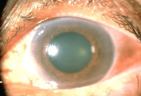 Glôcôm và việc gây tổn hại thần kinh thể giác