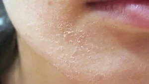 Tình trạng da thiếu hụt Ceramide NP