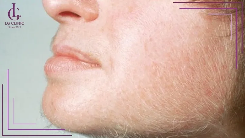 Lông trắng mọc trên mặt